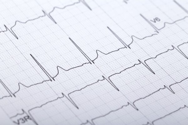 EKG (Electrocardiogram)